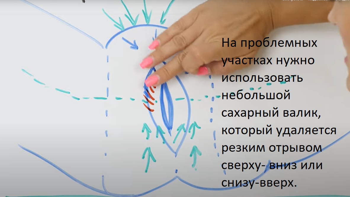 Схема депиляции глубокого бикини